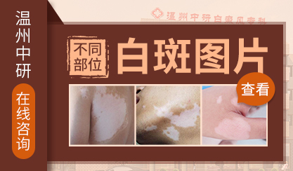 溫州白癜風(fēng)醫(yī)院排名